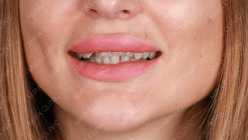 veneers reviews - case evaluation 